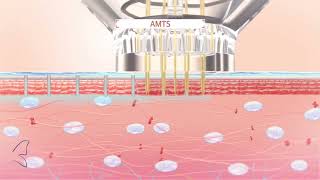 Introducing EPN Plus Microneedling with Electroporation [upl. by Martainn]