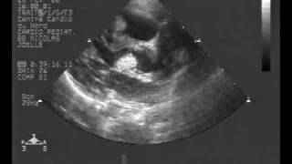 echocardiogram multiple rhabdomyoma tumorLong axis view [upl. by Madai]