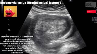 Endometrial polyp I Uterine polyp [upl. by Ng]