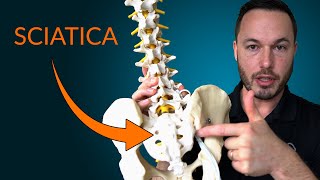 Understanding Sciatica Everything you need to know about the causes and treatment of sciatica [upl. by Erina]