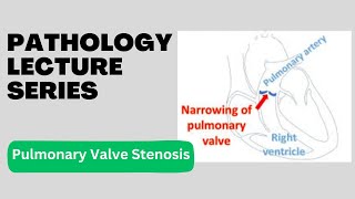 Pulmonary Valve Stenosis  Pathology Lecture Series  Lecture 17 [upl. by Gibbons828]