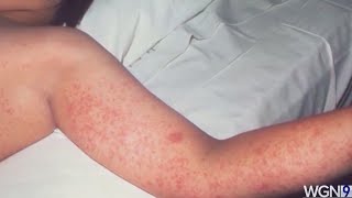 Are you protected against measles Symptoms and treatment explained [upl. by Aseefan523]