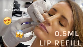 05ML LIP REFILL  NATURAL LOOKING FULL LIPS  LIP FILLERS  VIVA Skin Clinics [upl. by Ardnuaet]