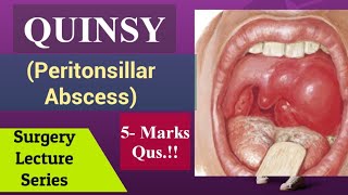 Peritonsillar AbscessQuinsy Surgery Lecture NEET PG Aspect in Tonsils Tonsillitis [upl. by Attenaj]