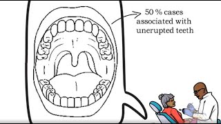 Calcifying Epithelial Odontogenic Tumor CEOT [upl. by Filberto]