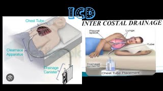 intercostal drainagerecurrent plueral effusionmbbsprocedure medicose Sudarshanlipane17 ⛑️⛑️🩺 [upl. by Moselle]