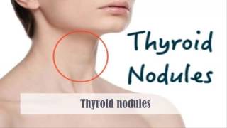 Thyroid nodules   Causes Symptoms Diagnosis Treatment Complications Prevention Risk Factors [upl. by Lubba]