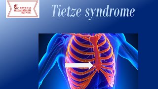 Teitze Syndrome [upl. by Earla623]