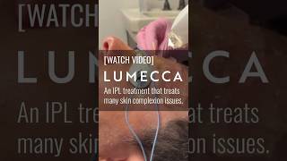 Patient treated with Lumecca IPL [upl. by Lamdin265]