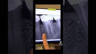 Endodontic retreatment of tooth 19 [upl. by Niwhsa]