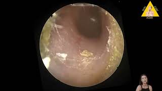 Ear wax removal with camera Yellow ear wax How does ear wax form OtoSet® Ear Cleaning [upl. by Aryamo]