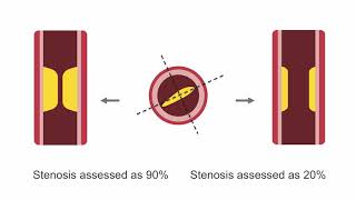 Assessing Lesion Severity in Coronary Angiography [upl. by Zetrok54]