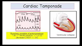 12DaysinMarch Tamponade and Constrictive Pericarditis for USMLE Step One Part II [upl. by Orianna969]