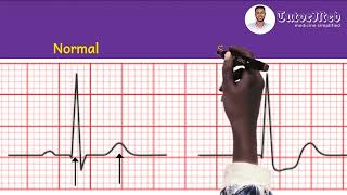 ECG changes of Unstable Angina amp NSTEMI  TutorMed electrocardiogram nstemi unstableangina usmle [upl. by Adnar]