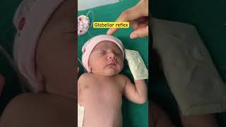 Reflex examination physiology  palmar reflex in newborn  Glabellar reflex in newborn  youtube [upl. by Adaval]