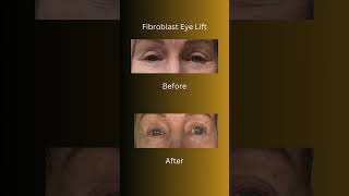 Fibroblast  Eye Lift  fibroblast plasmapen orangecounty [upl. by Erodeht]