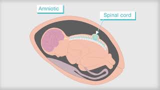 What is Spina Bifida [upl. by Aneetsyrk816]