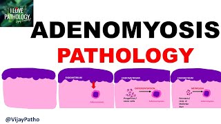 ADENOMYOSIS  Pathology Clinical Features Diagnosis amp treatment [upl. by Kan]