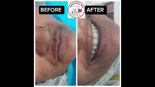 DENTAL IMPLANT SUPPORTED COMPLETE OVERDENTURE RESTORED FASCIAL AND DENTAL AESTHETIC amp FUNCTION [upl. by Pedaiah844]