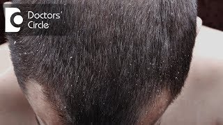 What is Dandruff and its treatment  Dr Shivashankar B Sajjanshetty [upl. by Lesley786]