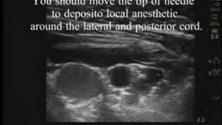 UltrasoundGuided Infraclavicular Block [upl. by Anelehs]