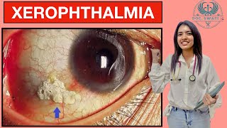 What is XEROPHTHALMIA  Learn about the WHO grading of XEROPHTHALMIA [upl. by Acined]