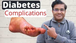 Complications of uncontrolled diabetes  6 complications examined [upl. by Verine353]