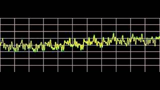 Osteoarthritis  Rife Frequencies [upl. by Yddub733]