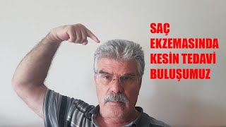 SAÇ EGZEMASINDA KESİN TEDAVİ BULUŞUMUZ [upl. by Eelyrehc]