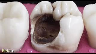 Root canal treatment procedure and a gold crown [upl. by Mcgraw]