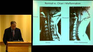 quotSyringomyelia Update Diagnosis Treatment and Researchquot  John D Heiss MD [upl. by Ojaras]