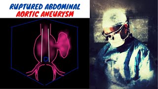 Ruptured Abdominal Aortic Aneurysm [upl. by Albemarle]