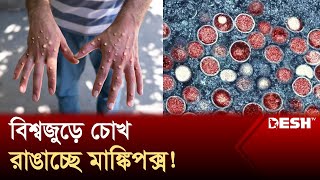 পাকিস্তান সুইডেনেও প্রাণঘাতী রোগের থাবা  Mpox Virus  Pakistan  News  Desh TV [upl. by Nilahs658]