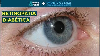 Retinopatia Diabética o que é sinais e sintomas tratamento  Diabetes e Você  Monica Lenzi [upl. by Yllut]