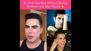 Ken Doll Claps back at people sharing his before and after pictures skin surgery [upl. by Enilekcaj525]