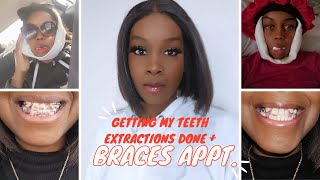 Getting my Teeth Extractions Done  Getting my Braces Finally  Lets talk Teeth Removal for Braces [upl. by Ymar]