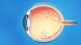 Understanding Glaucoma [upl. by Ainola344]