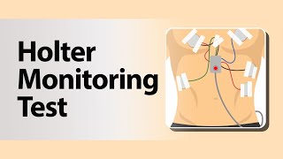 Holter Monitoring Test [upl. by Asiilanna]