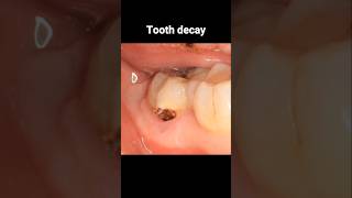 Filling tooth decay process dentistry dentist filling tooth [upl. by Ferdie295]