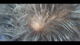 Pilar Trichilemmal Cyst Scalp Bloodless clean excision [upl. by Elatsyrc]