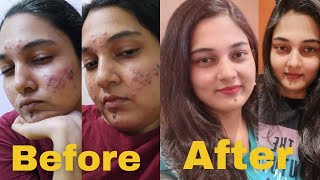 MY ACNE JOURNEY  MY EXPERIENCE WITH ISOTRETINOIN  HOW I CLEARED MY ACNE  USE OF TRETINOA005 [upl. by Didier]