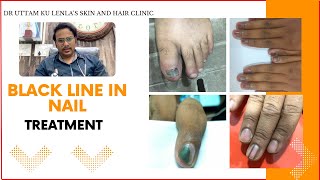 Black lines on nails  Black nail काले नाखून का इलाज  Melanoma  Dr Uttam Lenka [upl. by Scotti]