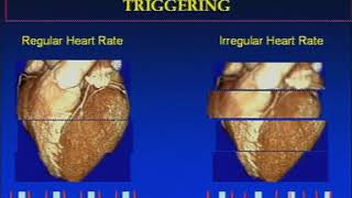 The Basics of Coronary CT Angiography [upl. by Annaohj653]