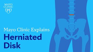 Mayo Clinic Explains Herniated Disk [upl. by Sillihp552]