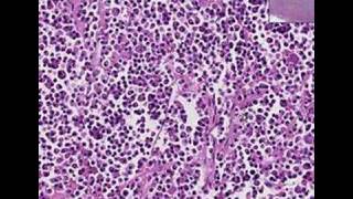 Histopathology NoseExtramedullary plasmacytoma [upl. by Airetak]