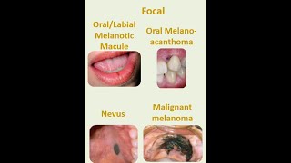 8 Focal melanosis [upl. by Blythe]