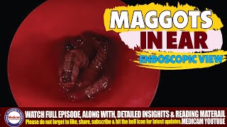 Maggots Myiasis Infestation in the Ear  Symptoms Causes Treatment and Removal of Ear Maggots [upl. by Acisey733]