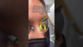 Laser for cherry angioma removal shorts redspot cherryangioma [upl. by Zuleika661]