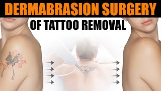 Surgical Treatment For Tattoo Removal by Dermabrasion  Care Well Medical Centre [upl. by Fiore]