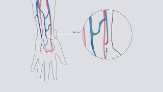 Understanding hemodialysis [upl. by Lyssa]